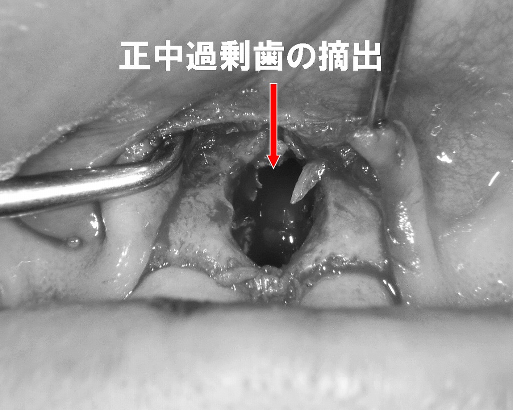 正中過剰歯の抜歯：頬側から骨を開削して行う埋伏歯の摘出