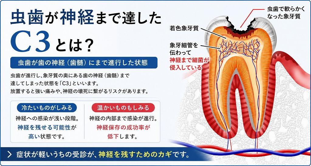 虫歯が神経まで達したC3とは？