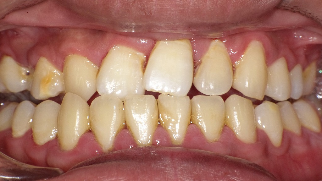 歯石除去で起こりうる「歯原性菌血症」：炎症が進んだ歯ぐきのリスクとは