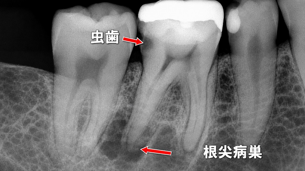 神経を抜く治療(抜髄)が必要なケース:深い虫歯と根尖病巣のレントゲン像