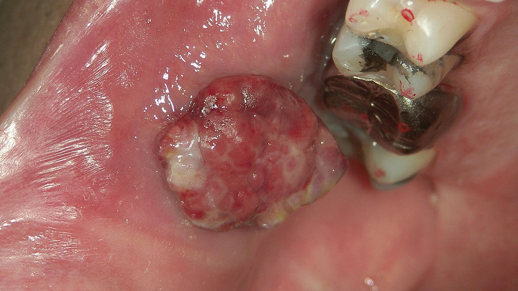 化膿性肉芽腫との鑑別が必要な口腔がん所見