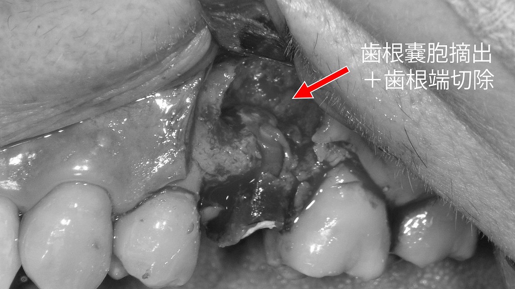 上顎5番部において歯根嚢胞を摘出後、歯根端切除を施行した術中所見。感染源となる歯根端部を切除し、逆根管充填としてMTAセメントを用いて封鎖を行っている。術後の再感染防止と骨治癒の促進を目的とした処置である。