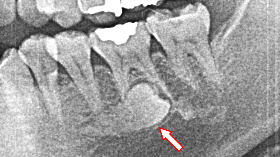 過剰歯のレントゲン画像