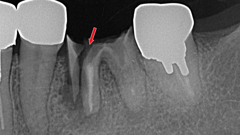 下顎６番の近心根が割れた