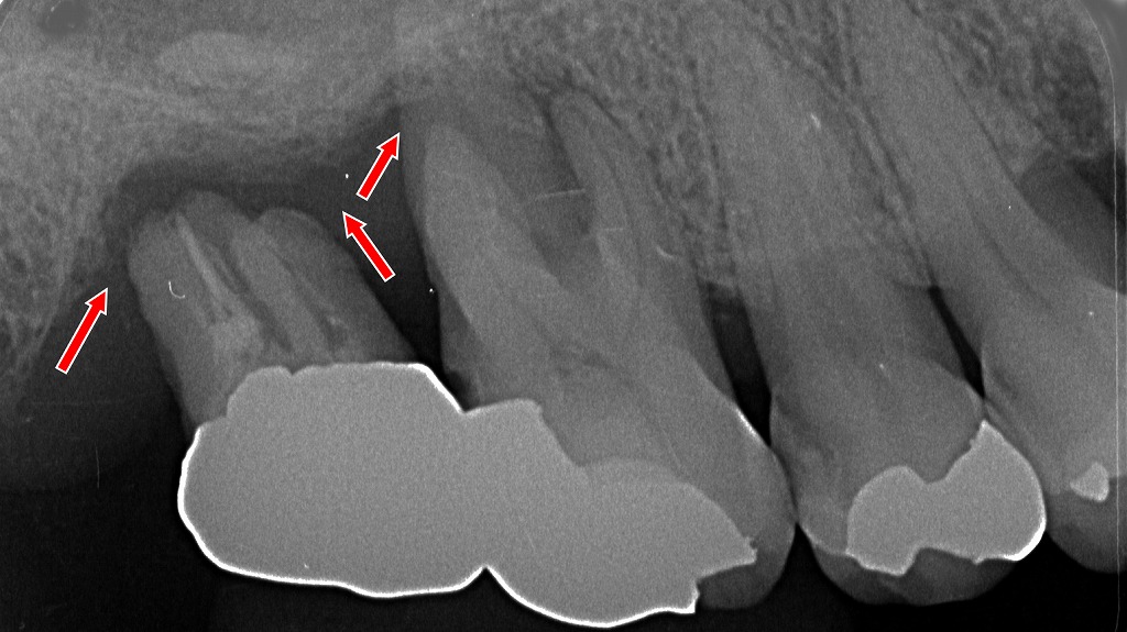 急性発作を起こした重度歯周病：上顎6・7番に及ぶ歯槽骨の著しい吸収像