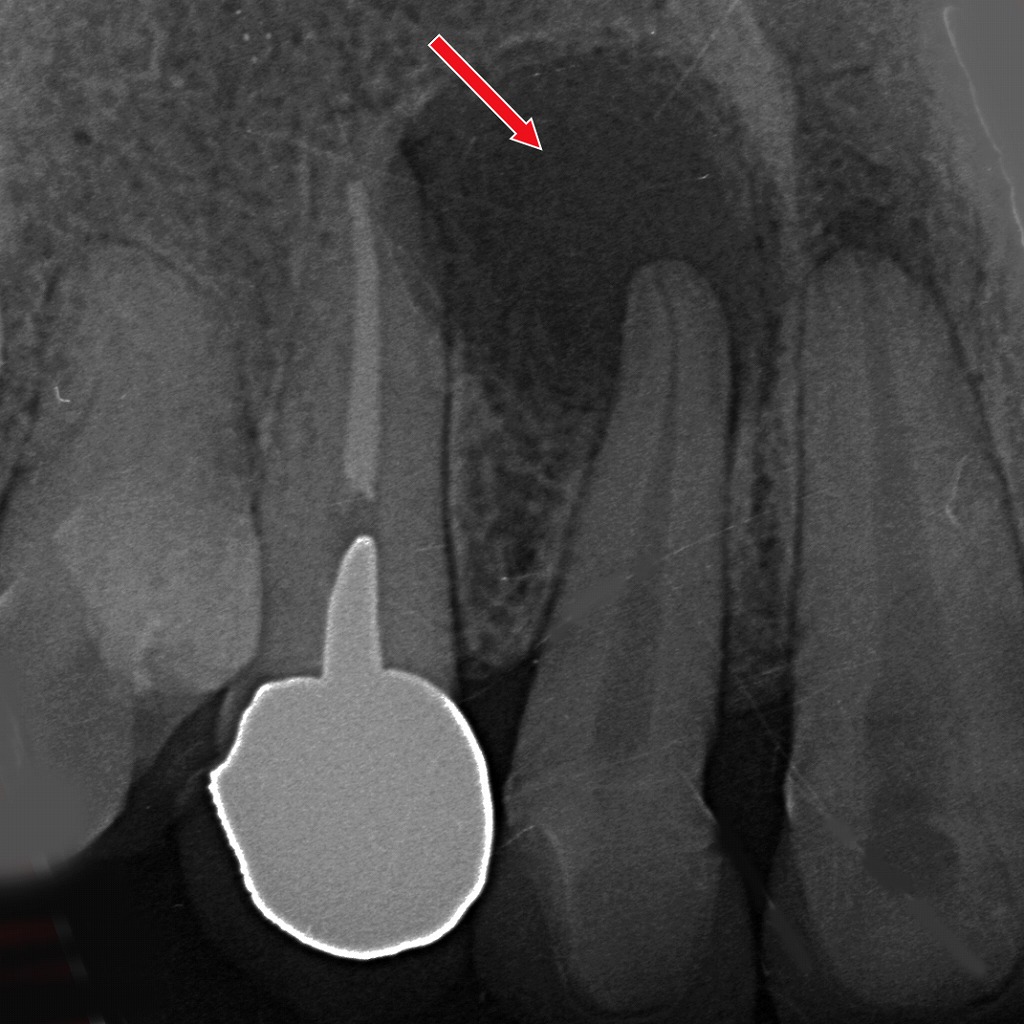 ビスフォスフォネート製剤と顎骨壊死のリスク
— 根尖病巣などの慢性炎症がある場合の注意点 —