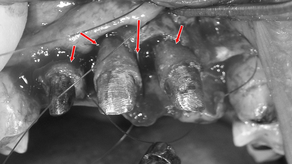 歯周外科治療（フラップ手術）による重度歯周病部位の徹底的なデブライドメント