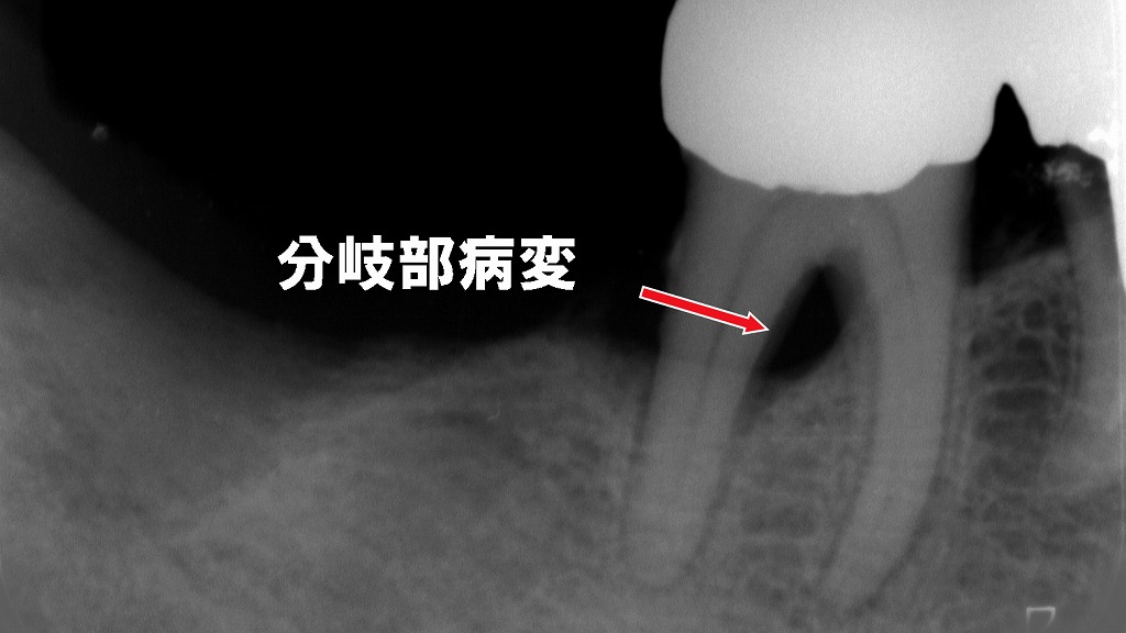 分岐部病変を見逃さないためのプローブ選択と使い分け
