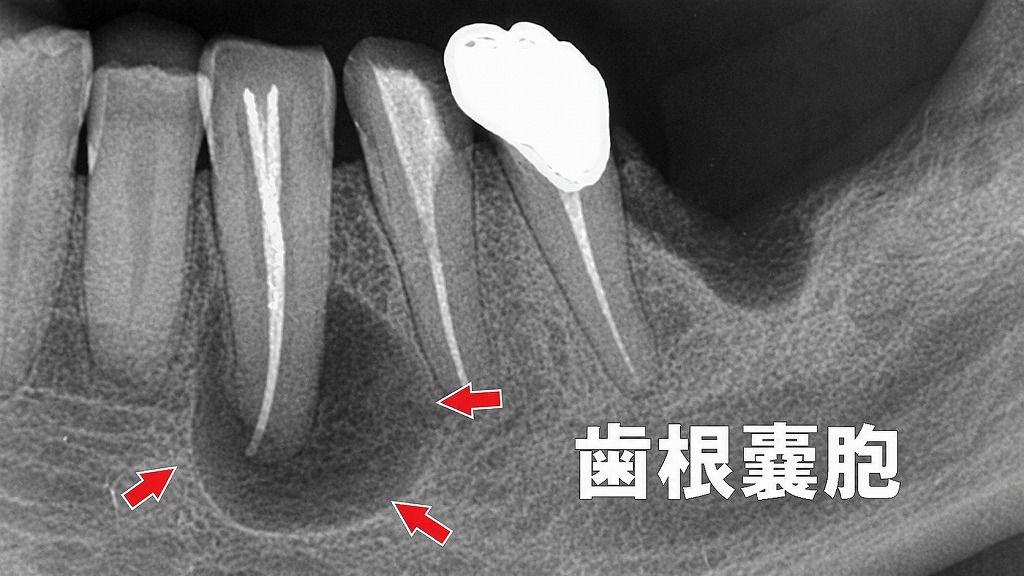 根尖性歯周炎による歯根嚢胞の形成