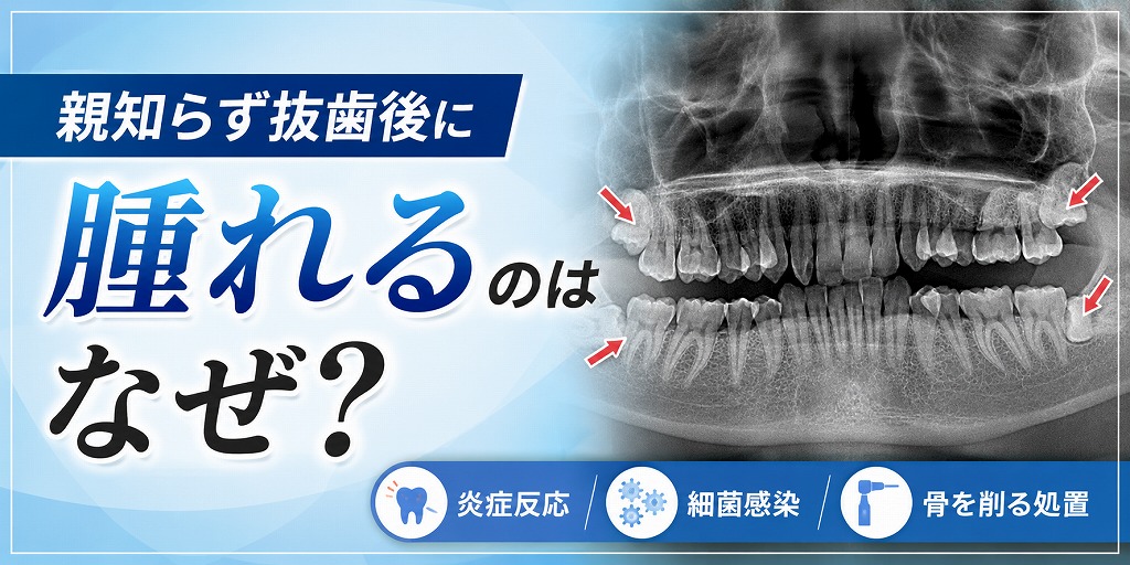 親知らず抜歯後に腫れるのはなぜ？