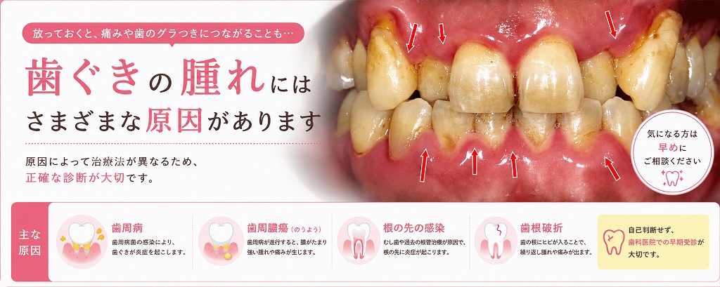 歯ぐきの腫れにはさまざまな原因があります