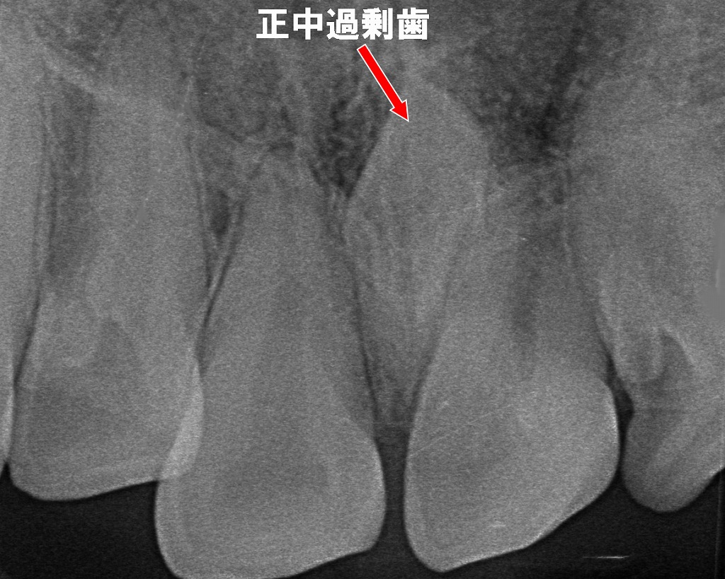正中過剰歯の存在を確認：将来の歯並びを守るための抜歯が必要なケース