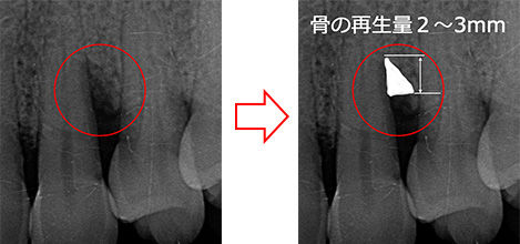 再生療法の有効性:2〜3mmの歯槽骨再生