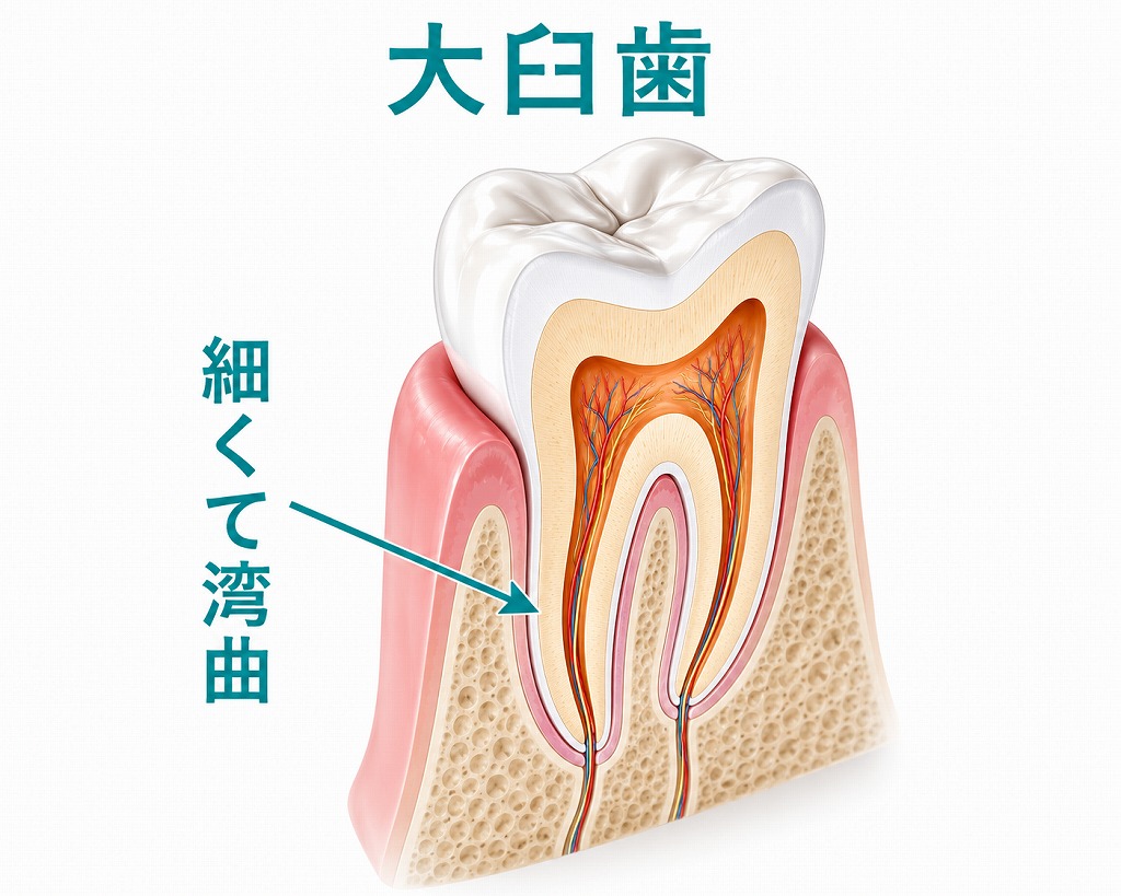 【奥歯（大臼歯）】治療が難しい