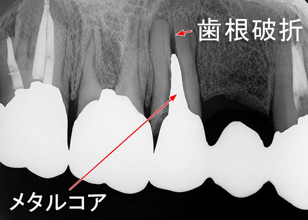 症例1:ブリッジの支台歯となった上顎第二小臼歯の歯根破折