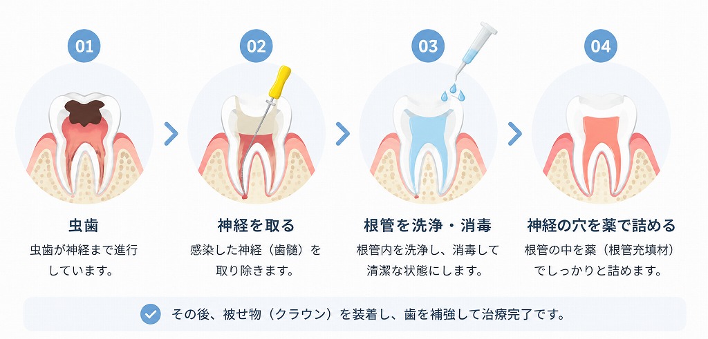 歯の神経を抜く治療