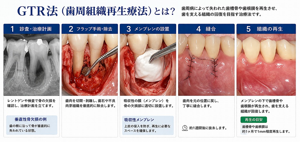 GTR法の基本ステップ