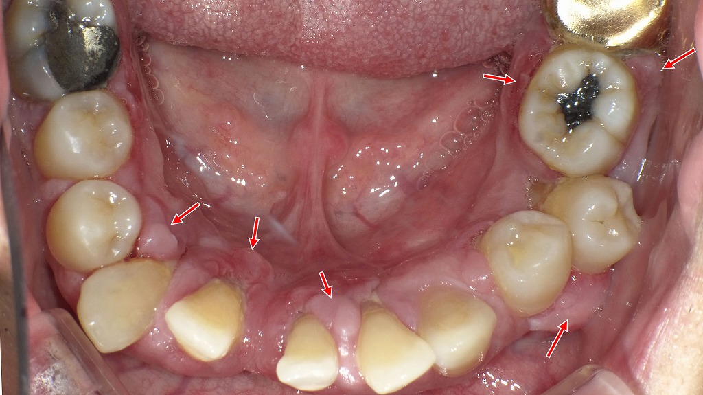 重度歯周病による歯肉腫脹 ― 炎症が広範囲に及んだ口腔内所見