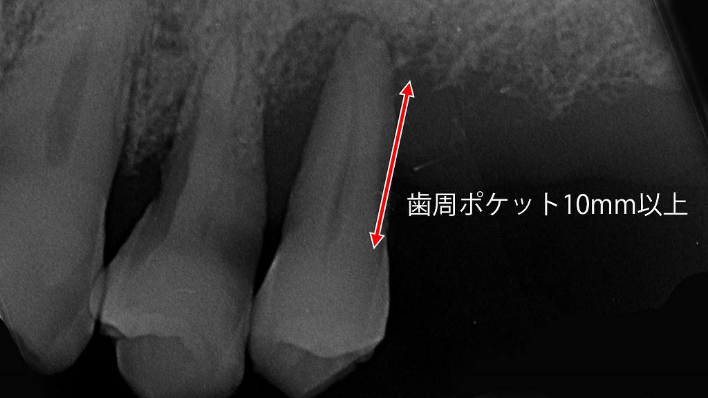 歯周ポケット10mm以上のレントゲン画像