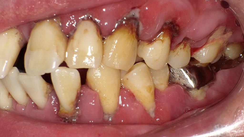 重度歯周病の症例:左側面