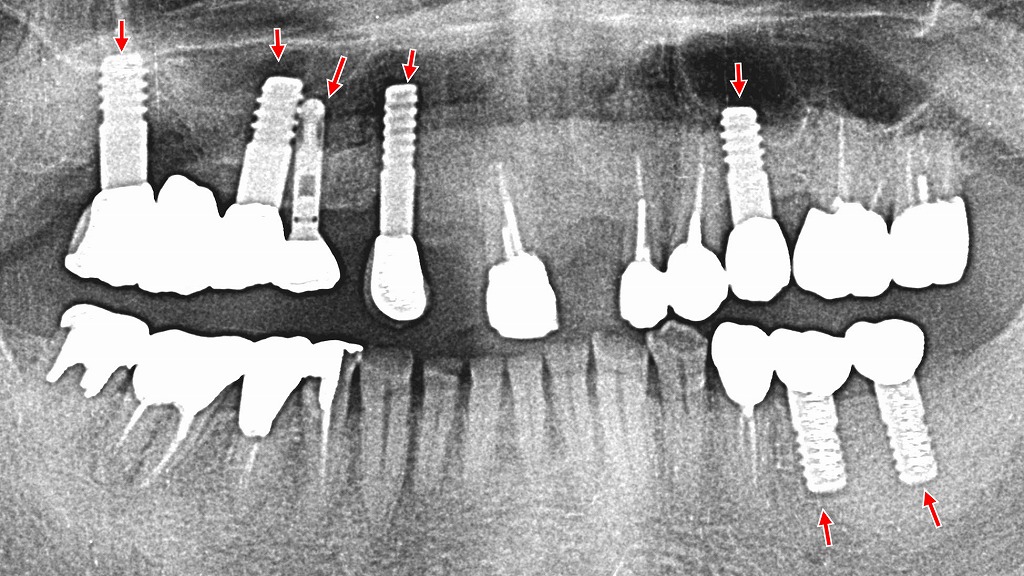 インプラント埋入手術