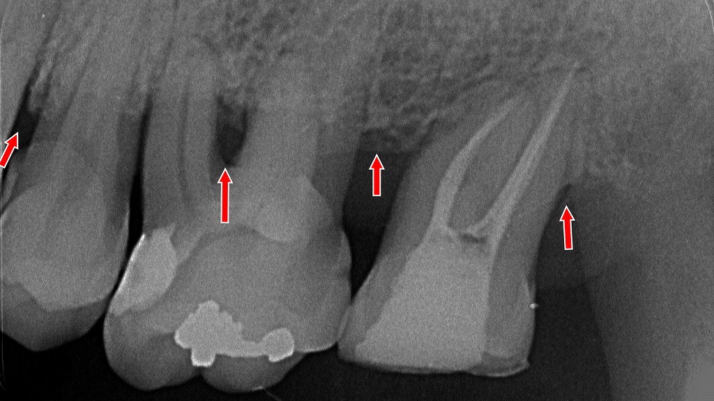 重度歯周病で歯石が多量に付着。1〜2ヶ月ごとの定期除去が必要