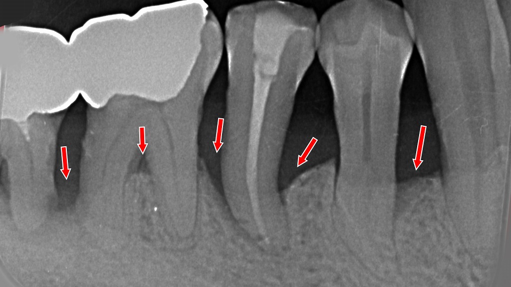 「矢印部分：歯周病で骨が均一に低下する“水平性骨吸収”の所見。