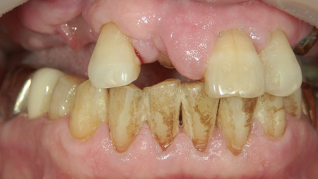 歯周病の改善例：歯石除去と正しい歯磨きで炎症が軽減