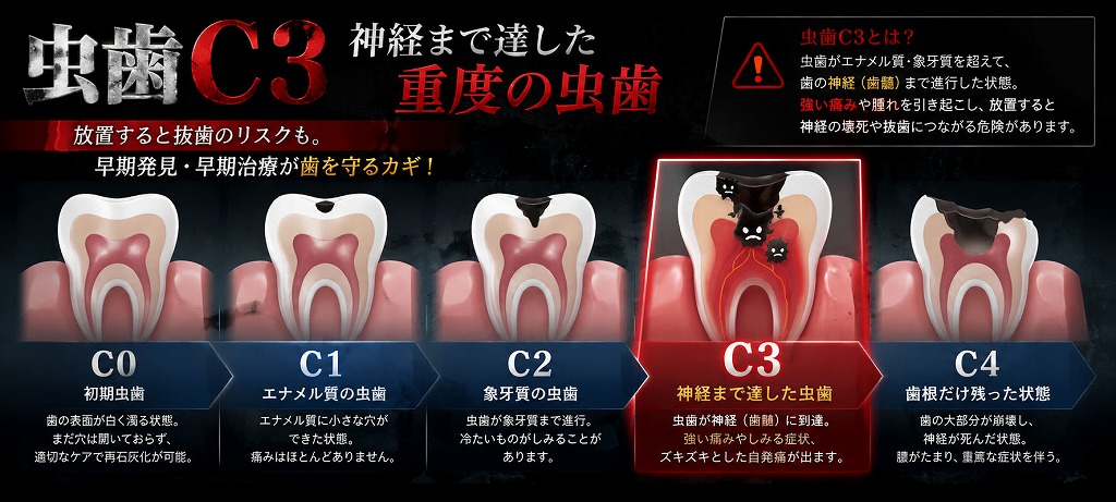 虫歯の進行度「C0〜C4」