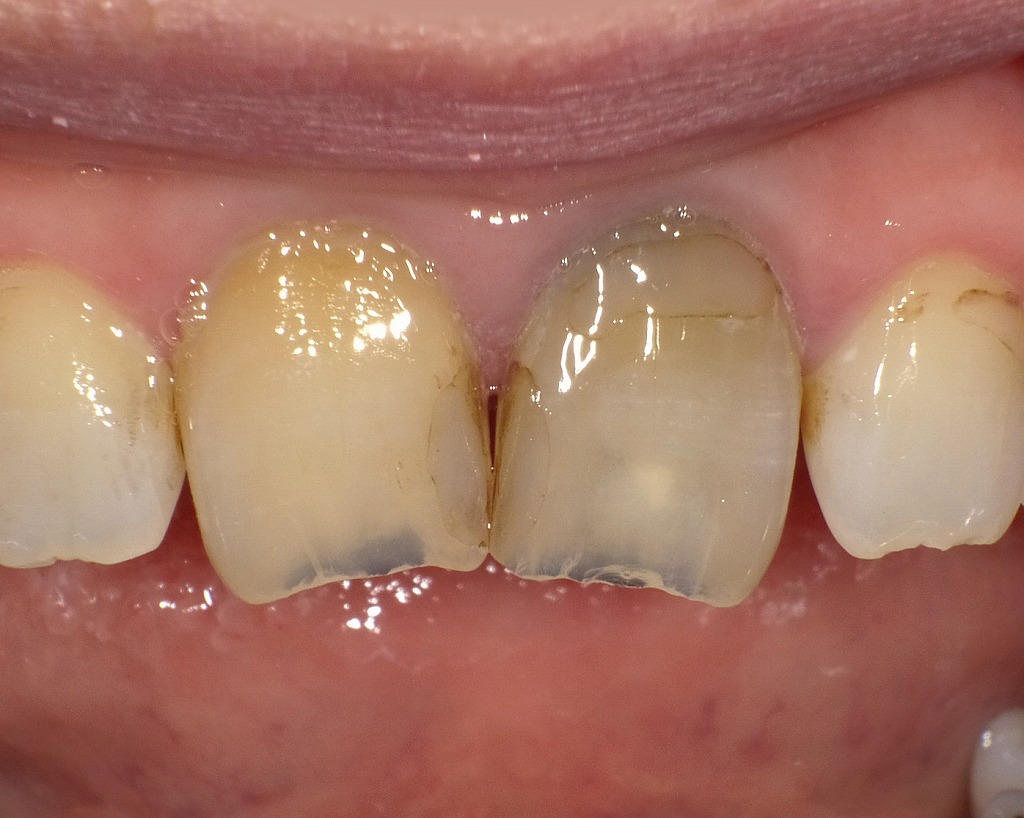 神経を失った歯は、内部の水分量や構造変化により徐々に暗く変色します。写真のように、左右の前歯で色の差が生じることは珍しくありません。