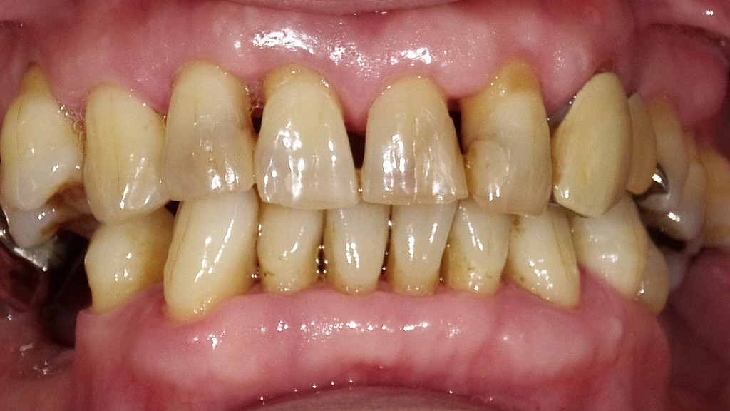 術後：SRP施術後