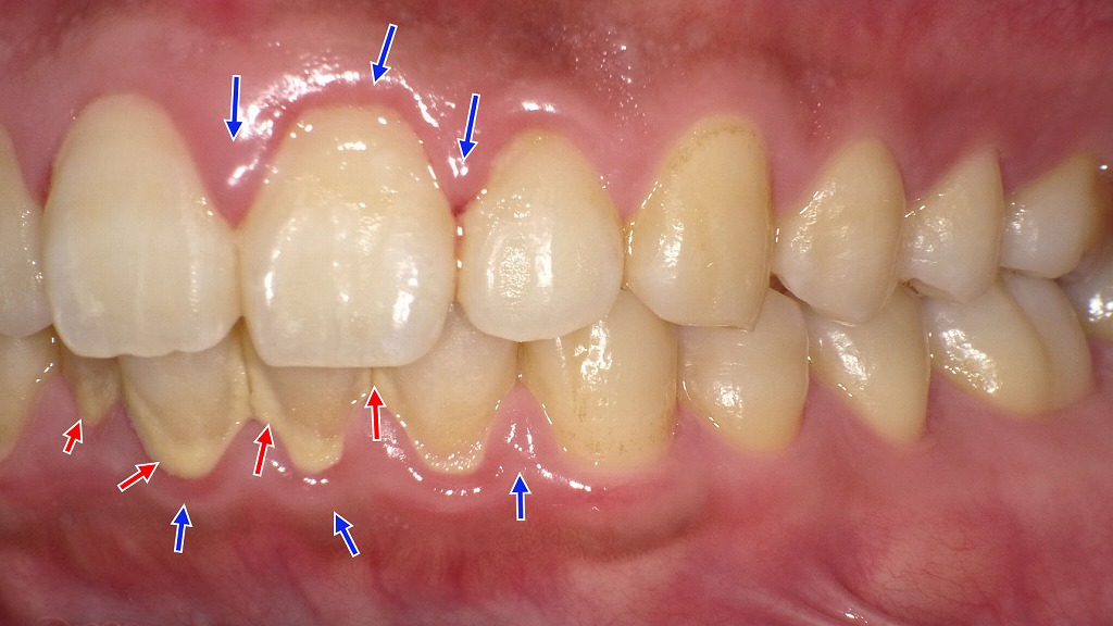 歯周病治療|歯石除去で歯ぐきの炎症を改善