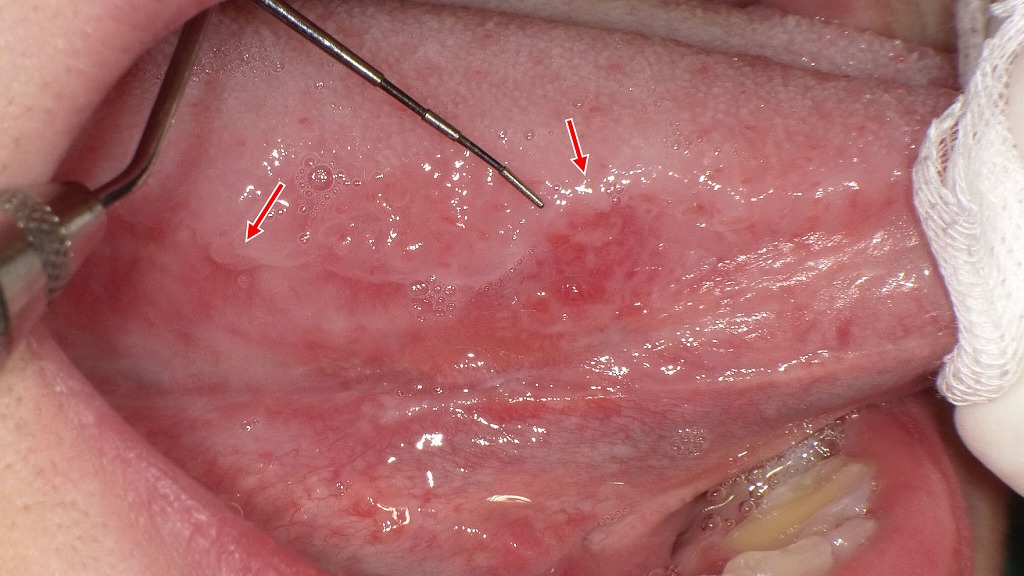 舌側縁に認められる紅板症の疑いの病変