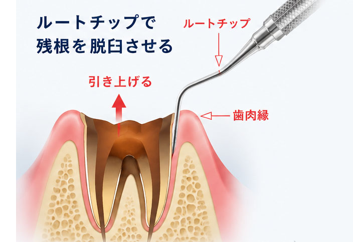 外科的挺出法