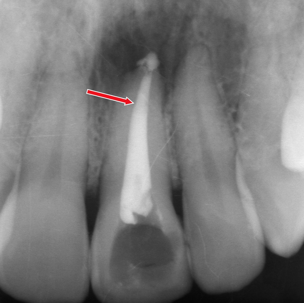 失活歯の根管を清掃・消毒し、根の先までしっかり根管充填を行った状態です。