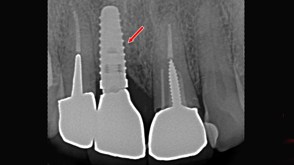 左上１番のインプラント