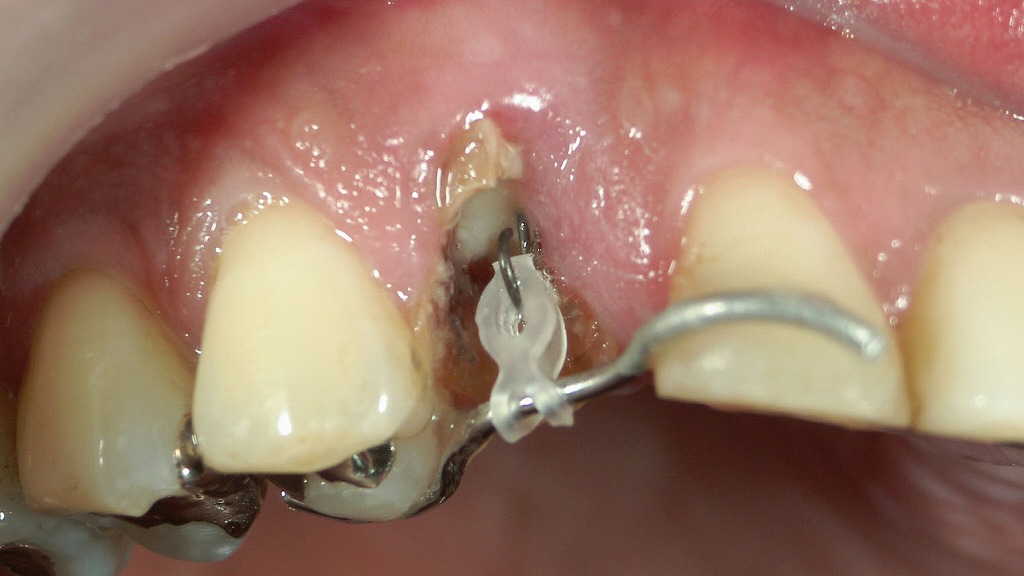 歯を残す選択肢「エクストルージョン」