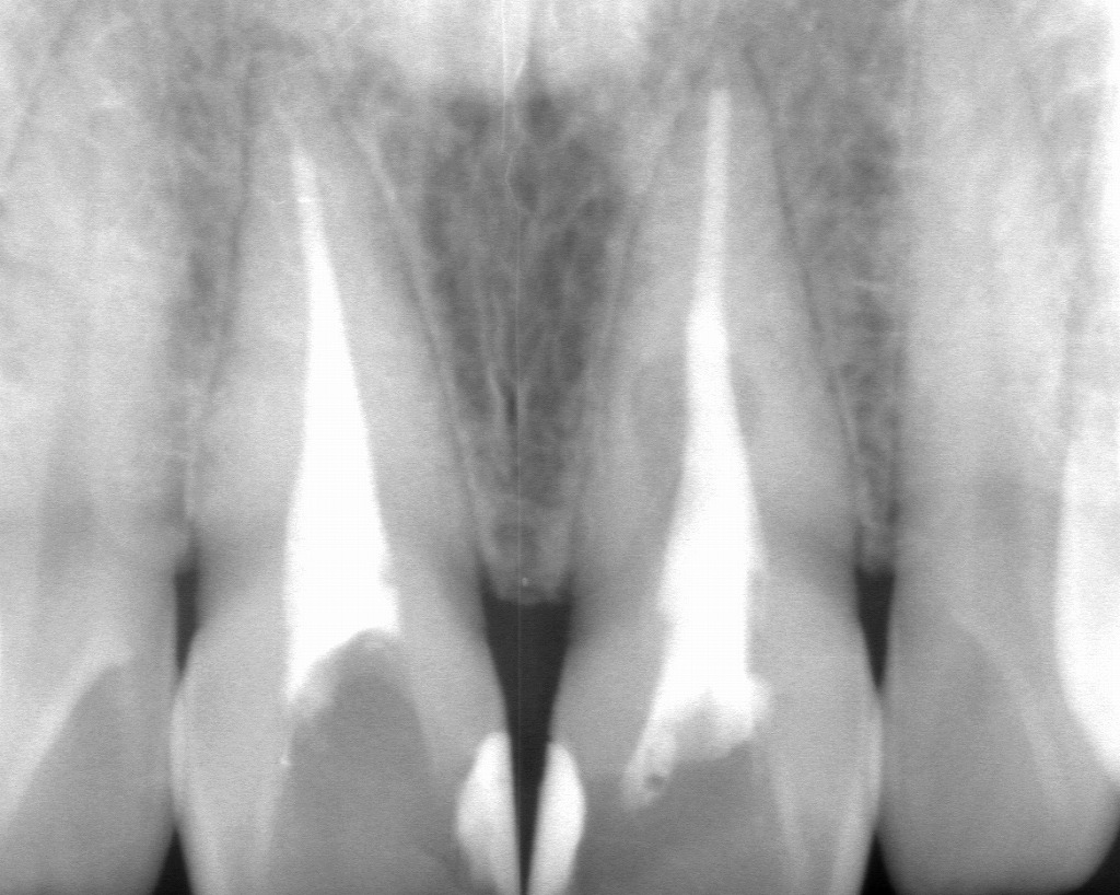 レントゲンでは、神経が除去され根管充填材が入った状態が確認できます。治療自体は適切でも、神経を抜いた歯は経年的に色調変化が起こりやすくなります。