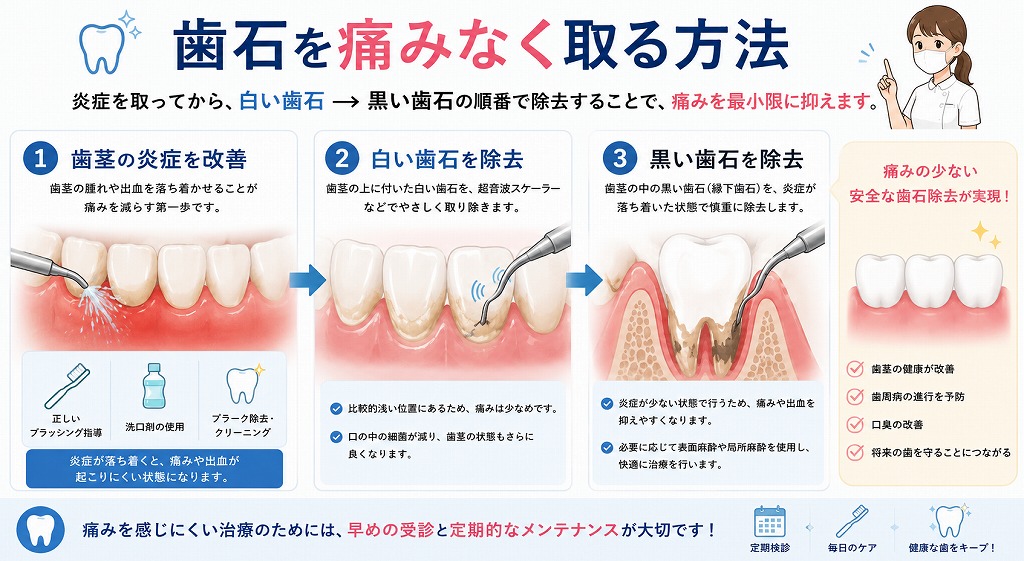 歯石を痛みなく除去する方法