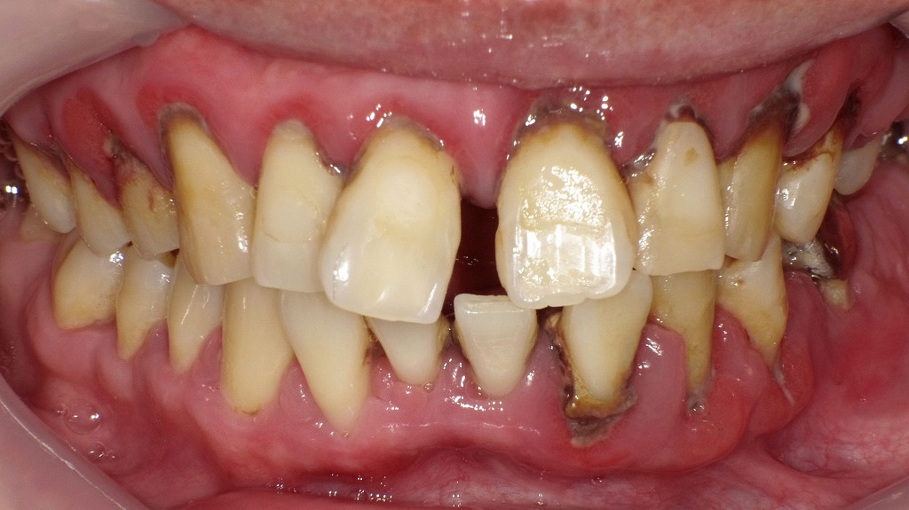 重度歯周病の症例:正面