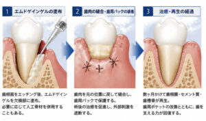 エムドゲイン法（歯周組織再生療法）