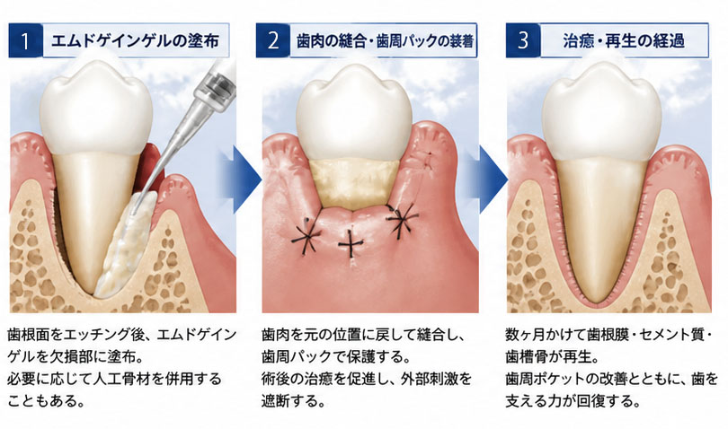 エムドゲインゲルの塗布