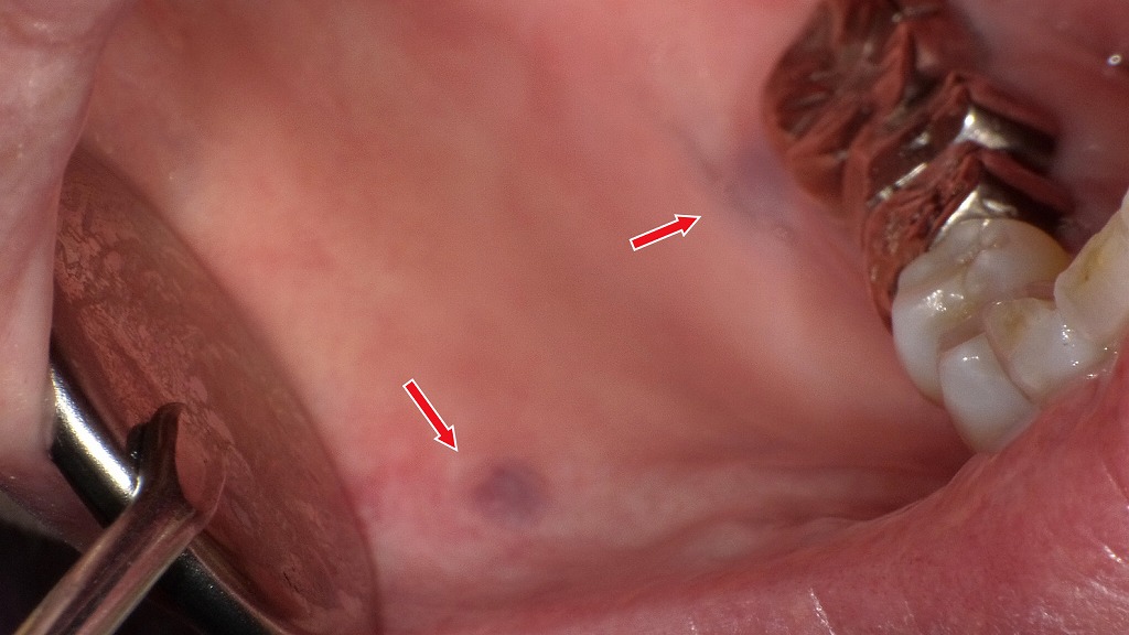 頬粘膜に出来た色素性母斑