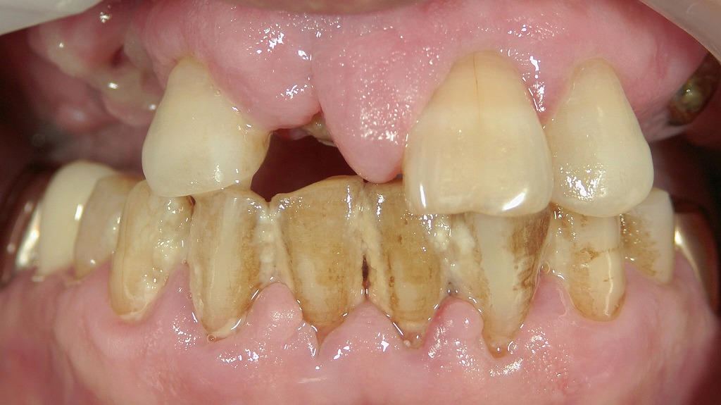 歯周病が心臓病を招く？全身に影響する“口腔内の炎症”