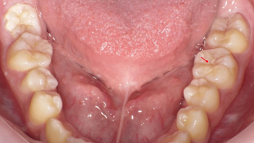 虫歯リスクを大幅に減らすシーラントによる予防ケア