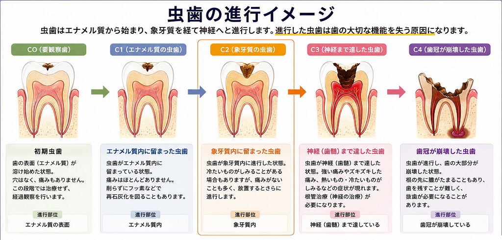 虫歯の進行イメージ