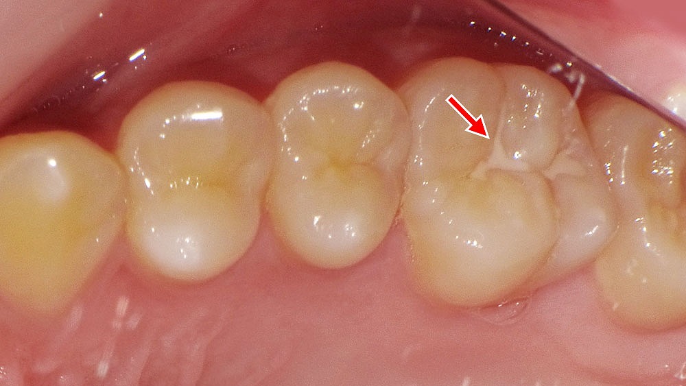 奥歯の溝を守るシーラントによる予防処置