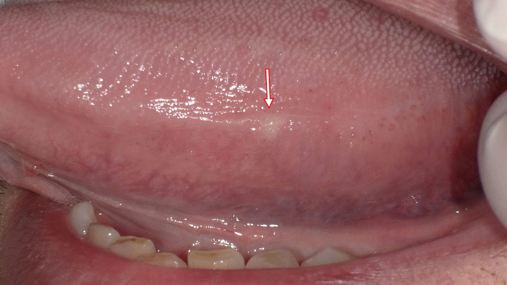舌粘膜に認められる白板症の初期所見