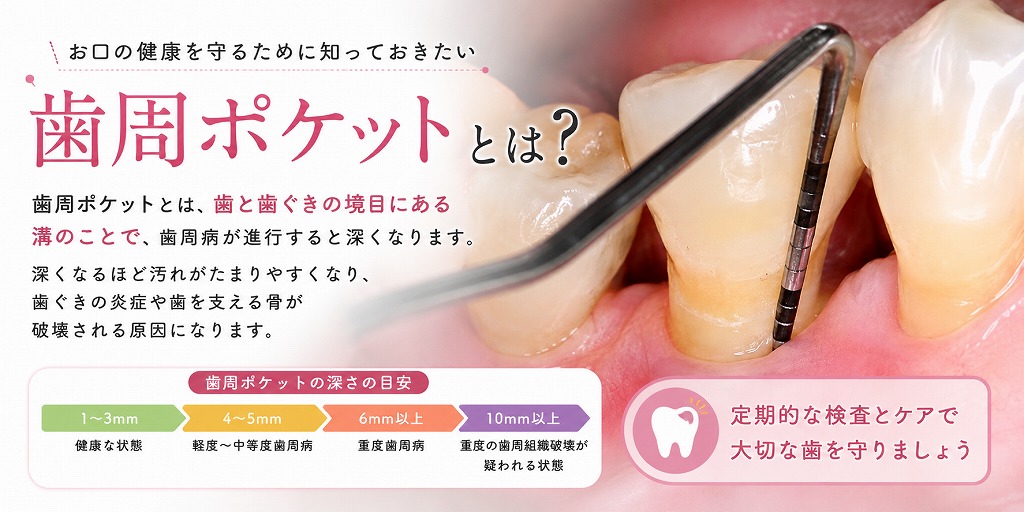 歯周ポケットとは？