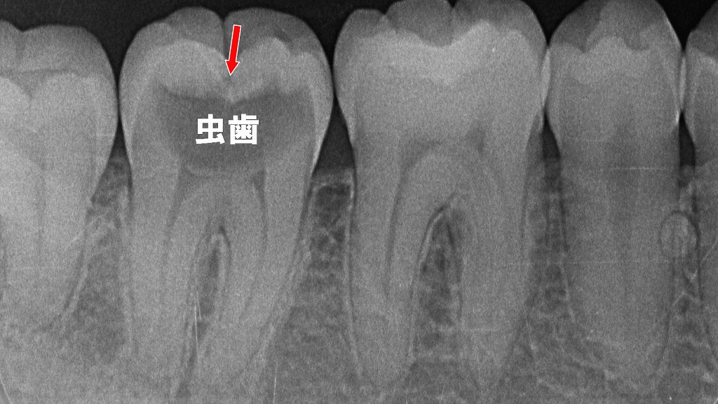 C2からC3へ進む虫歯の実態──表面に穴がなくても内部で急速拡大